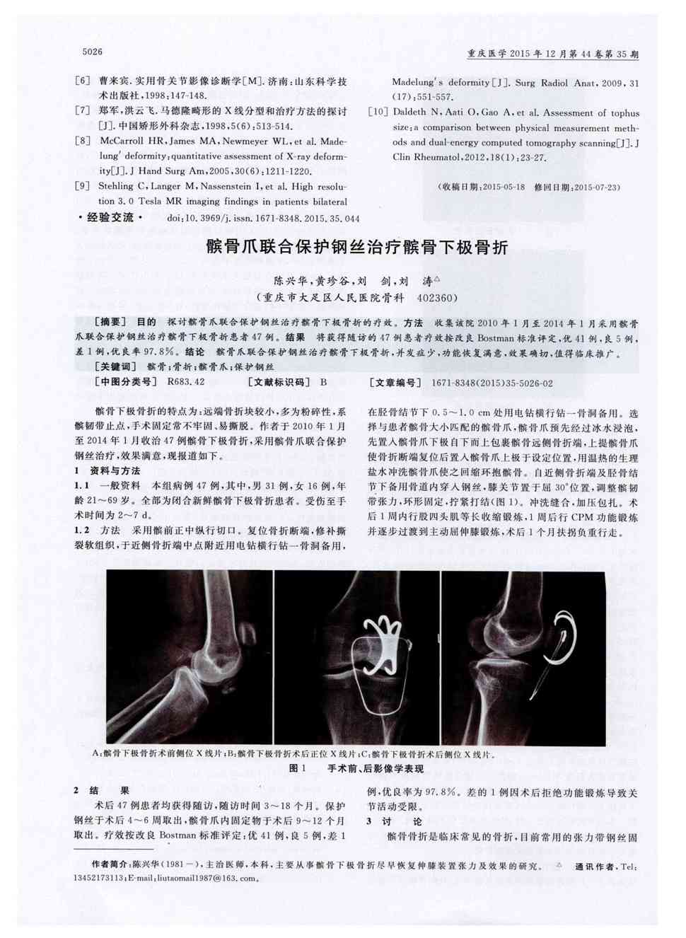 期刊髌骨爪联合保护钢丝治疗髌骨下极骨折被引量:2      目的探讨