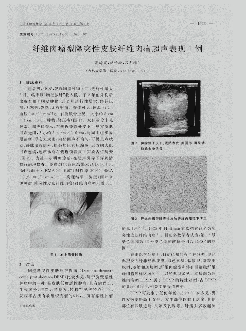 期刊纤维肉瘤型隆突性皮肤纤维肉瘤超声表现1例     1临床资料  患者