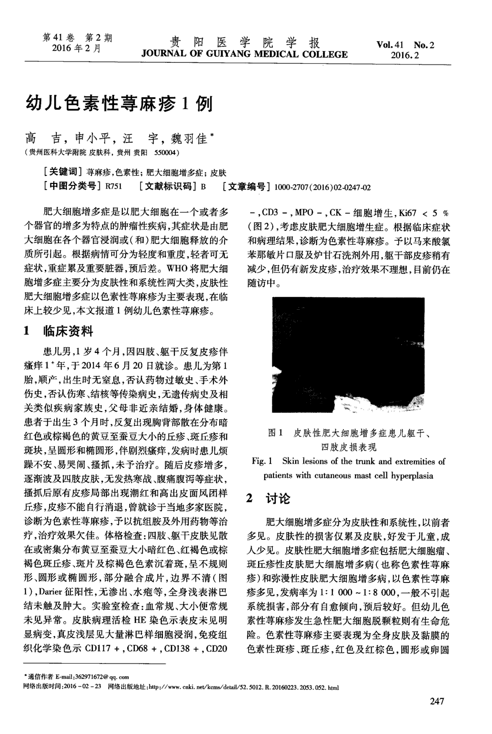 期刊幼儿色素性荨麻疹1例      肥大细胞增多症是以肥大细胞在一个