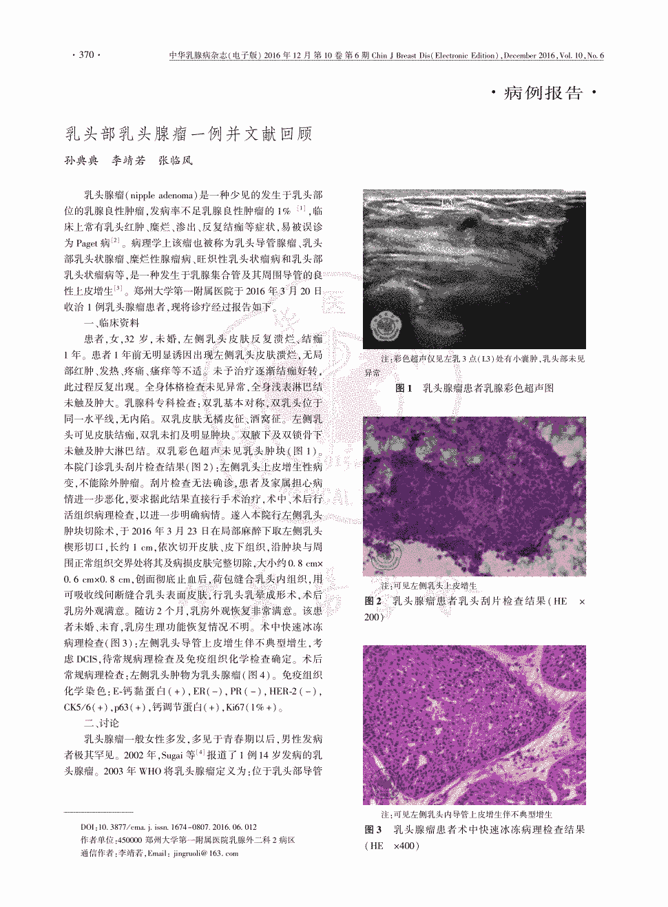 《中华乳腺病杂志(电子版)》2016年第6期370-372,共3页孙典典李靖若