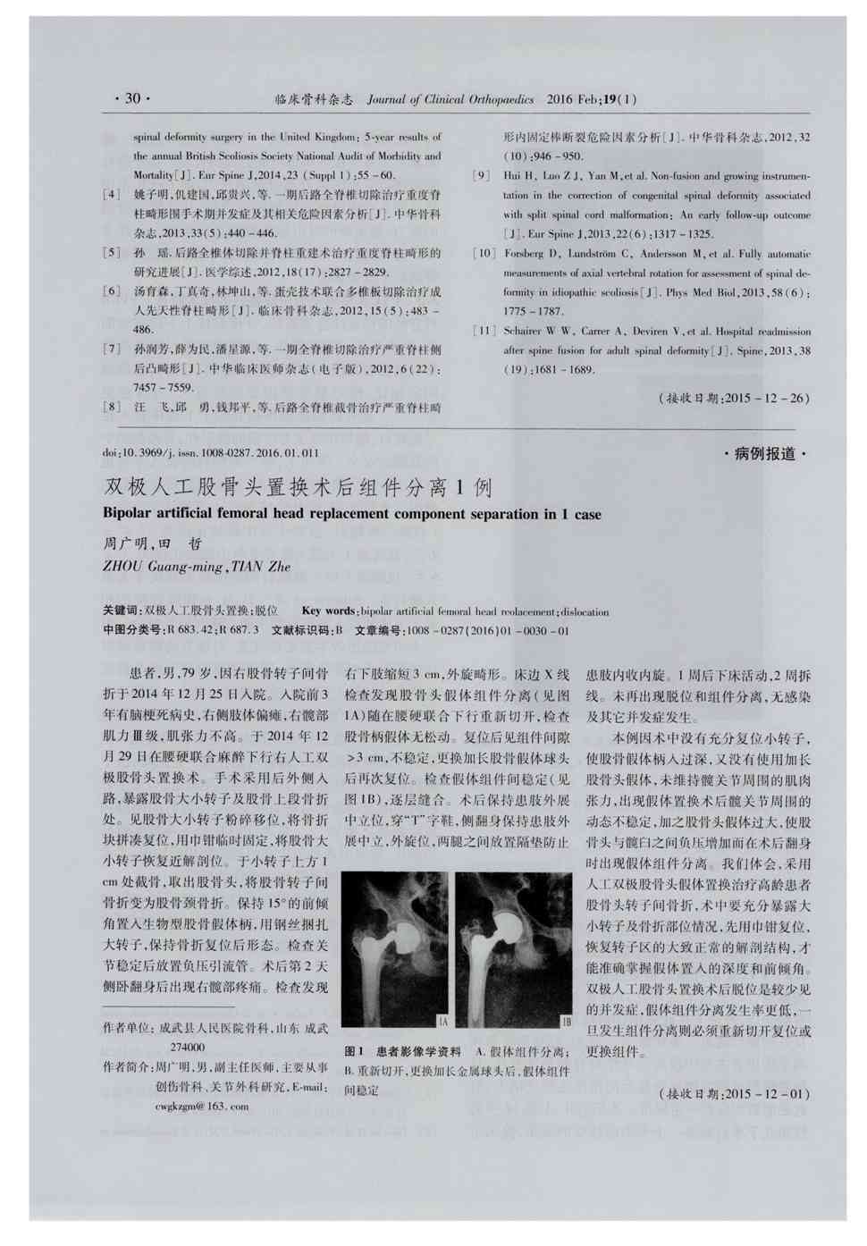 期刊双极人工股骨头置换术后组件分离1例被引量:1    患者,男,79岁