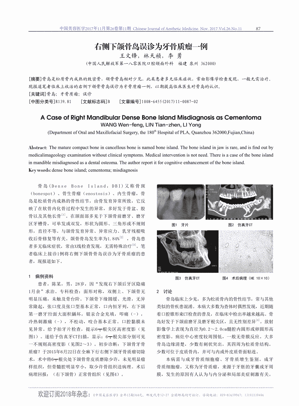 期刊右侧下颌骨岛误诊为牙骨质瘤一例     骨岛是松质骨内成熟的致密