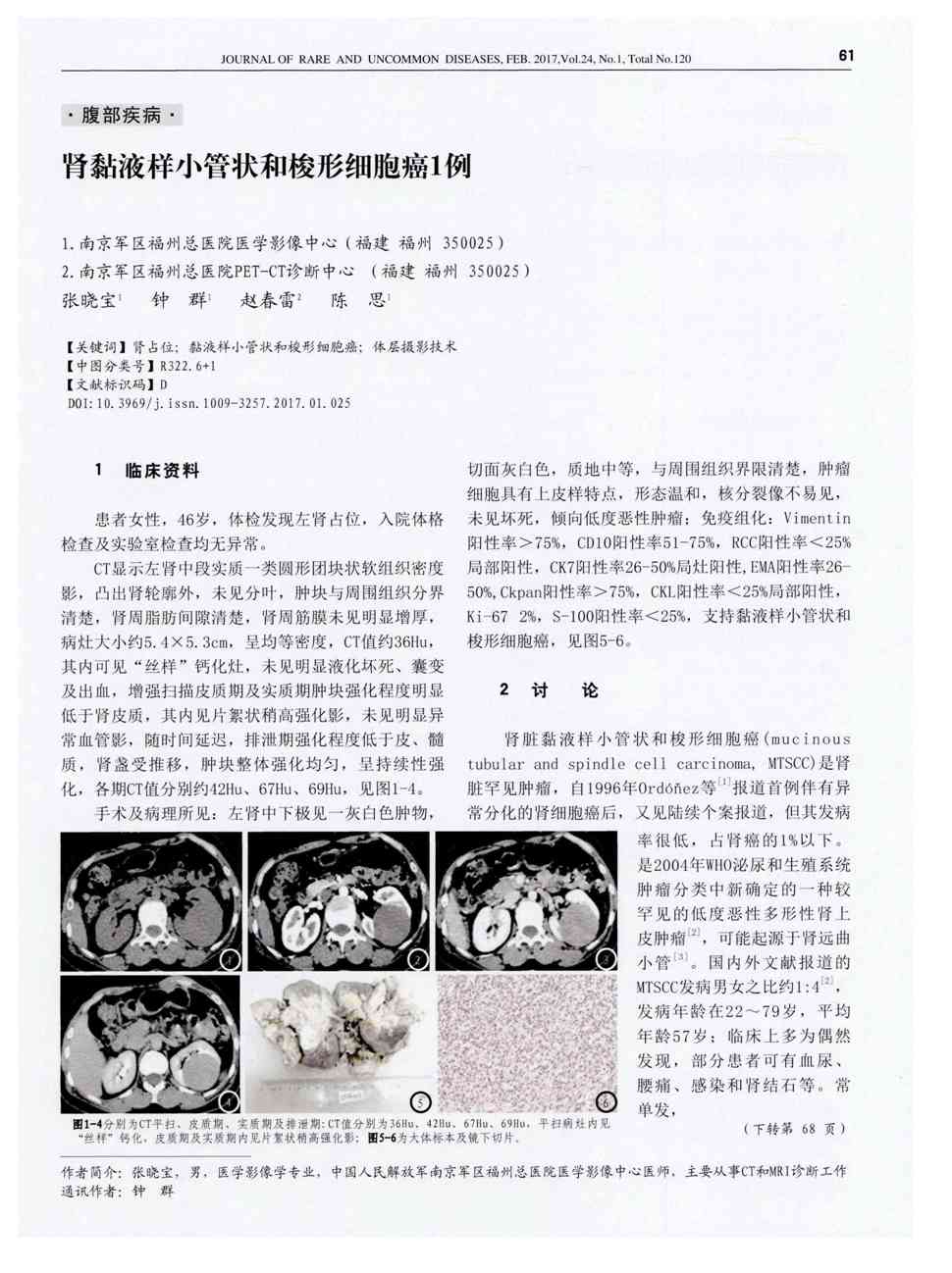 期刊肾黏液样小管状和梭形细胞癌1例被引量:1      1临床资料患者