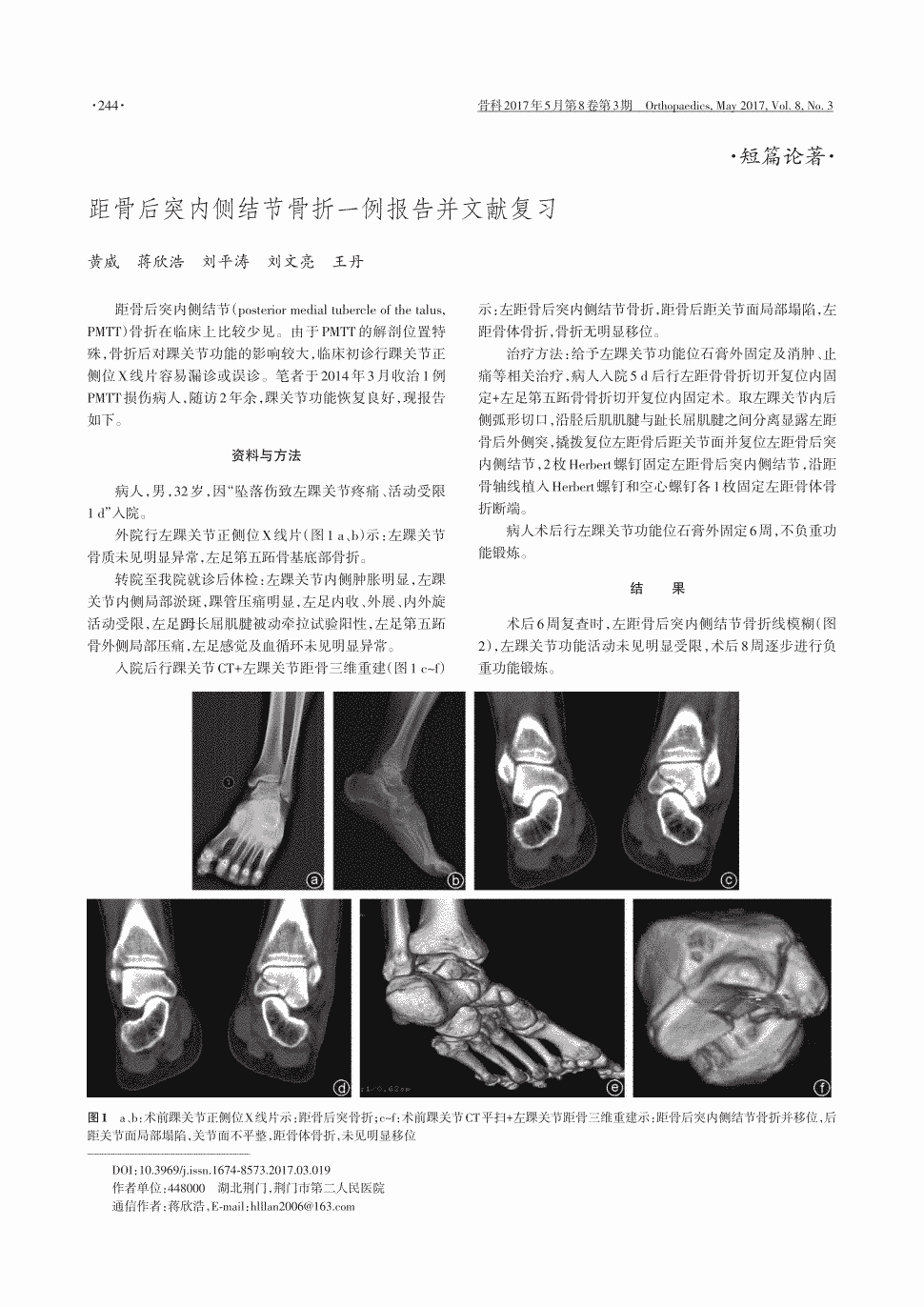 期刊距骨后突内侧结节骨折一例报告并文献复习       距骨后突内侧