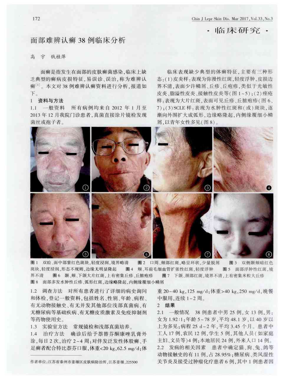 2    面癣是指发生在面部的皮肤癣菌感染,临床上缺乏典型的癣病皮损