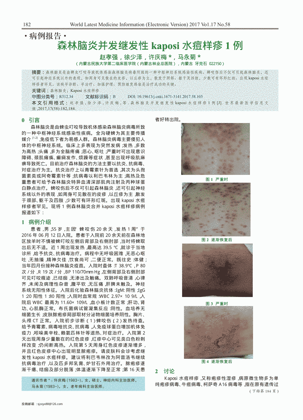 期刊森林脑炎并发继发性kaposi水痘样疹1例      森林脑炎是由蜱虫