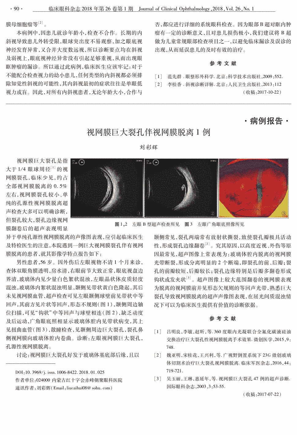 期刊视网膜巨大裂孔伴视网膜脱离1例   视网膜巨大裂孔是指大于1/4