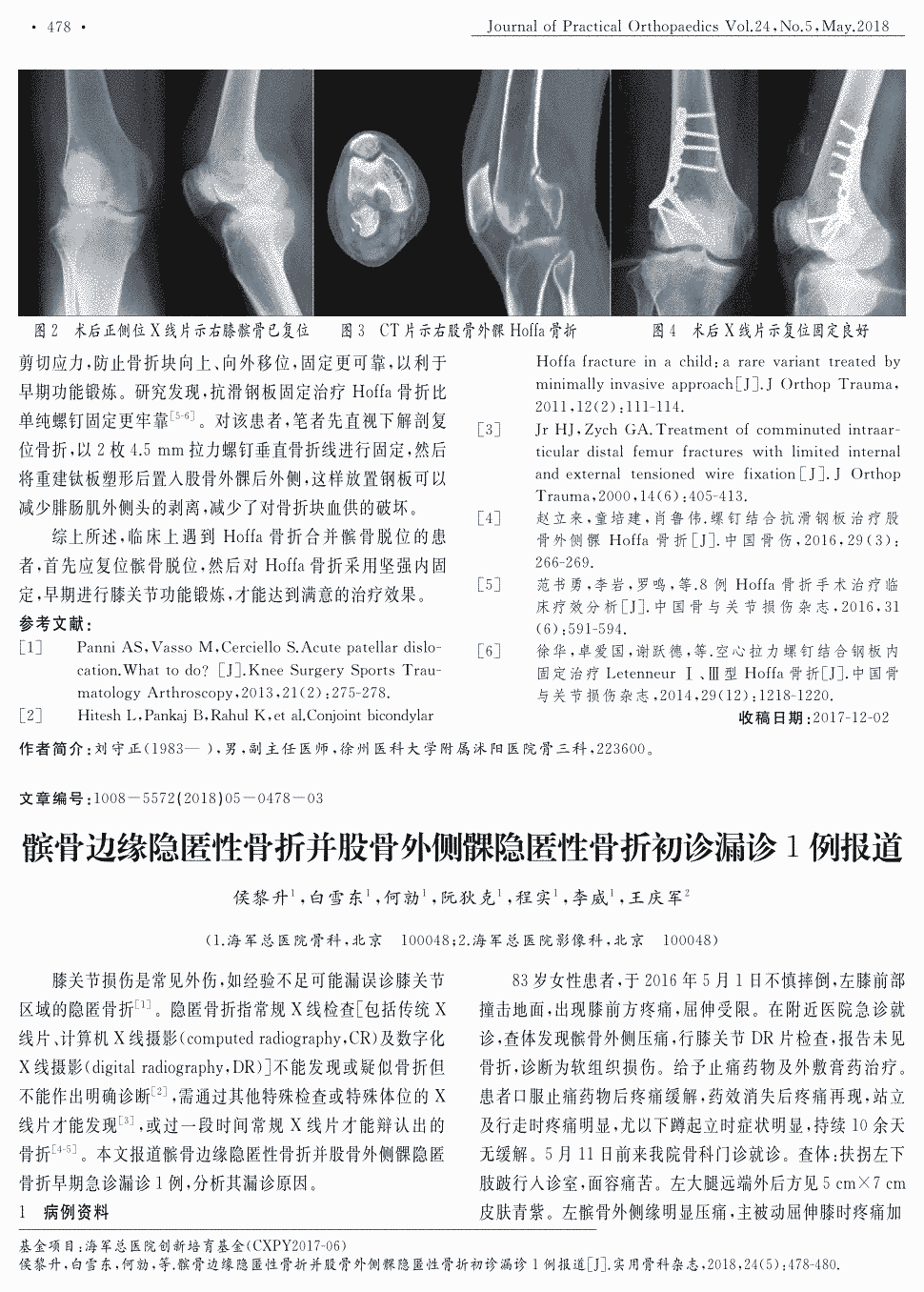 期刊髌骨边缘隐匿性骨折并股骨外侧髁隐匿性骨折初诊漏诊1例报道被引