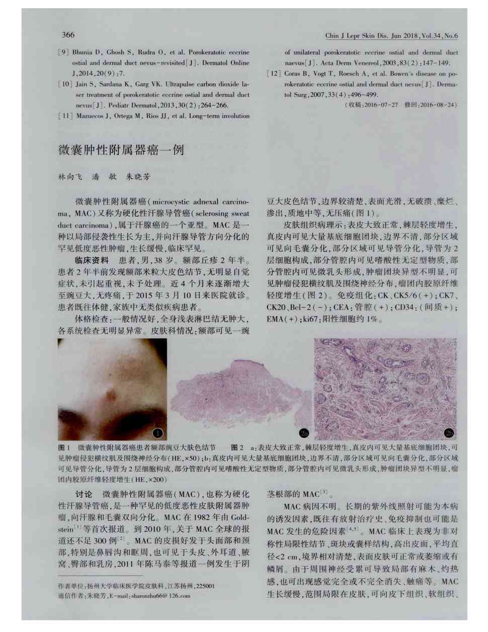 汗腺导管癌(sclerosing sweat duct carcinoma),属于汗腺癌的一个亚型