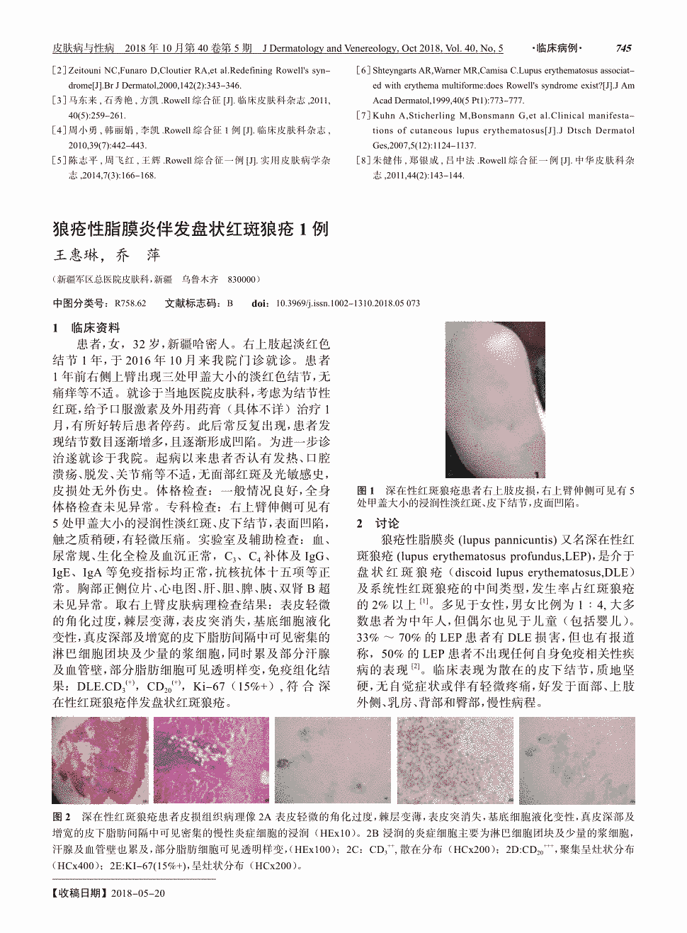 期刊狼疮性脂膜炎伴发盘状红斑狼疮1例    1临床资料  患者,女,32岁