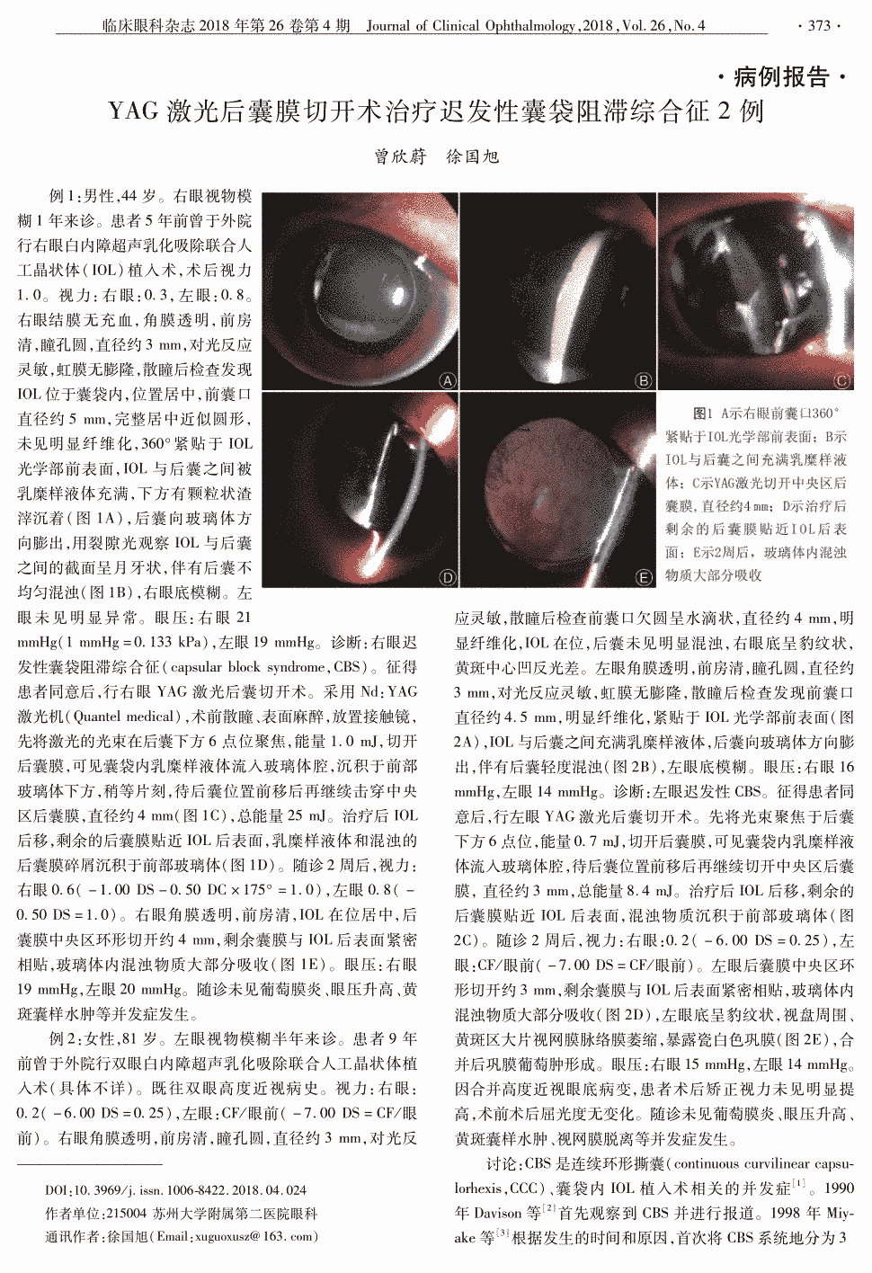 期刊yag激光后囊膜切开术治疗迟发性囊袋阻滞综合征2例    例1:男性