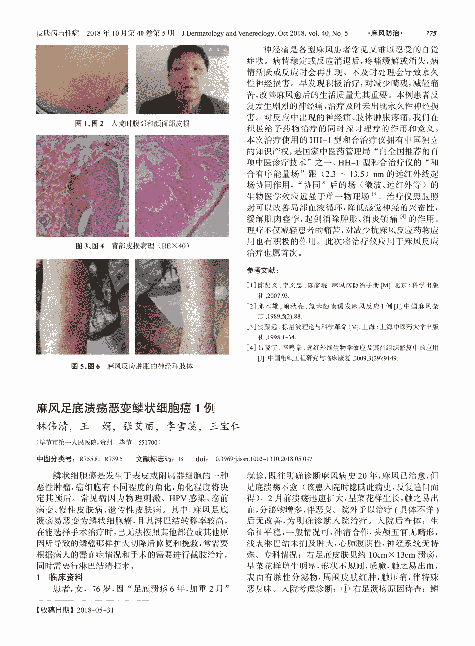 鳞状细胞癌是发生于表皮或附属器细胞的一种恶性肿瘤,癌细胞有