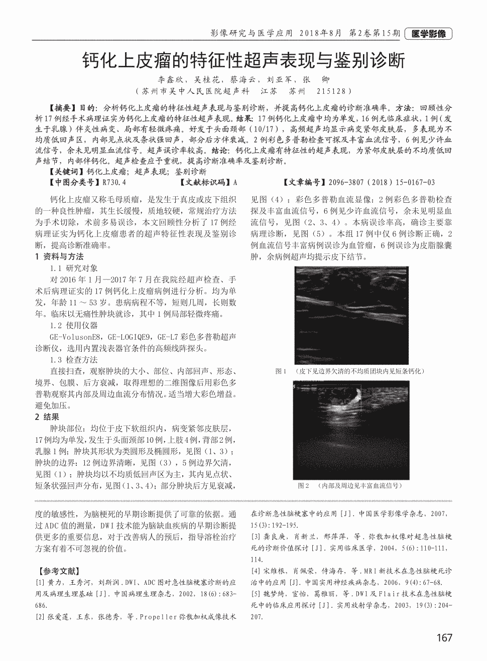 方法:回顾性分析17例经手术病理证实为钙化上皮瘤的特征性超声表现.