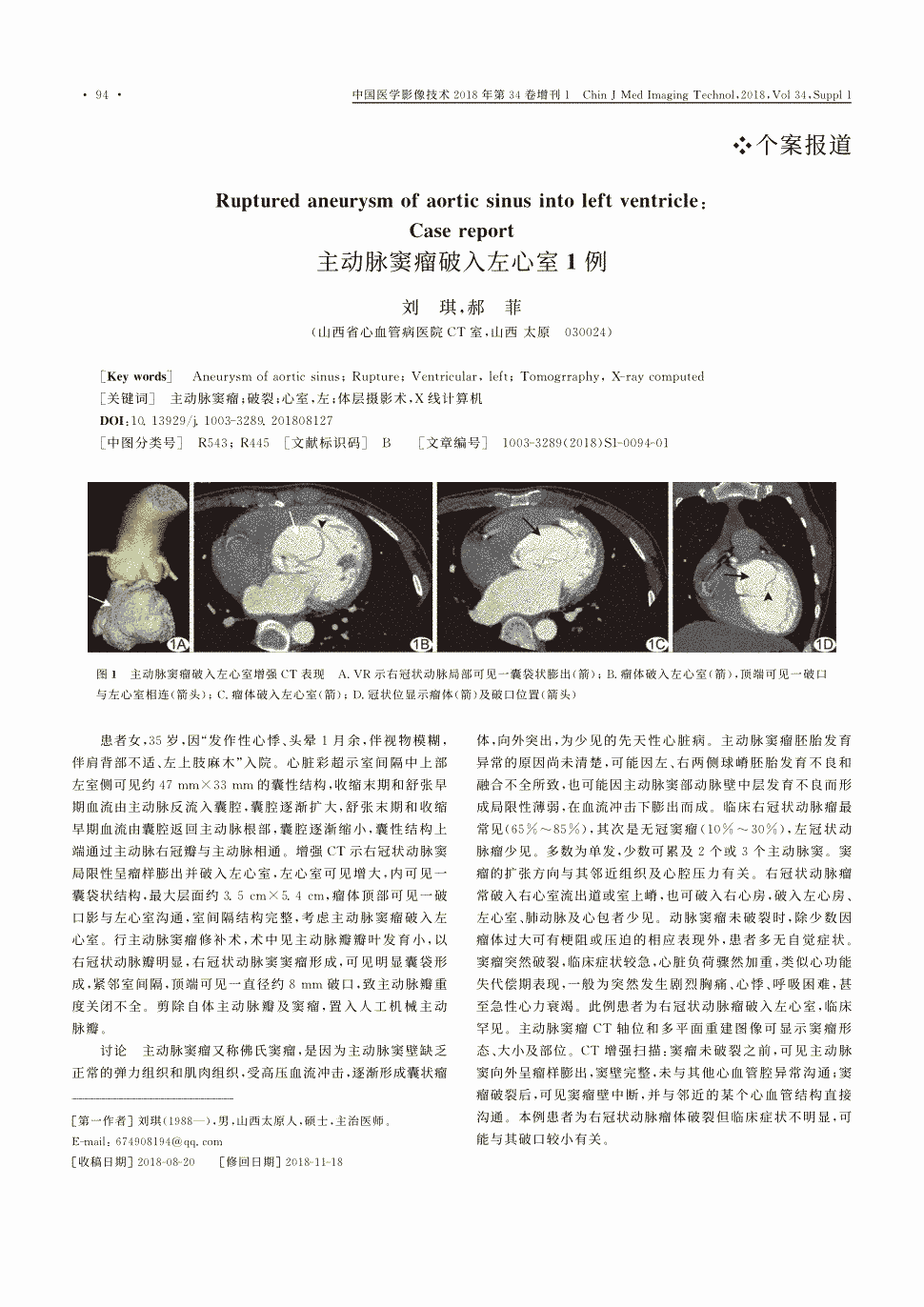 期刊主动脉窦瘤破入左心室1例    患者女,35岁,因'发作性心悸