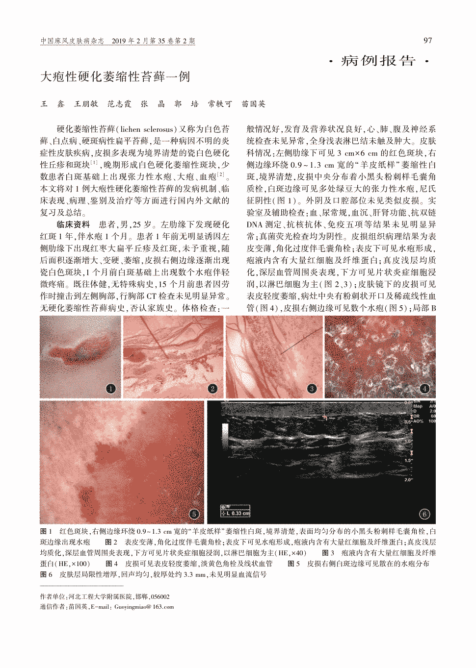 期刊大疱性硬化萎缩性苔藓一例         硬化萎缩性苔藓(lichen