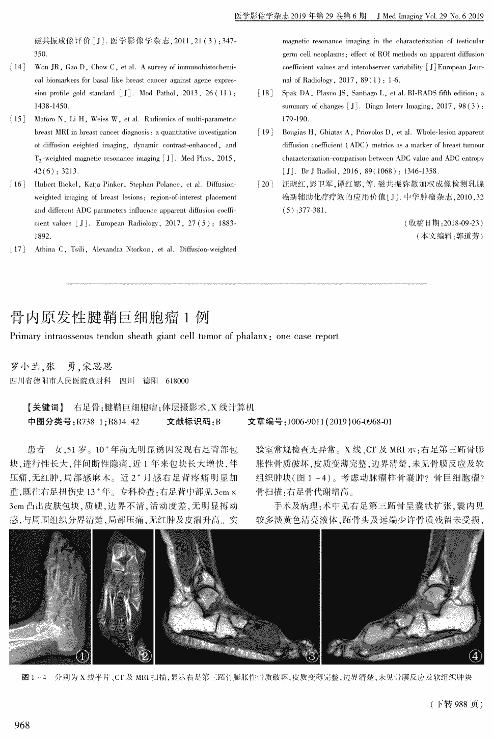 期刊骨内原发性腱鞘巨细胞瘤1例     患者 女,51岁.