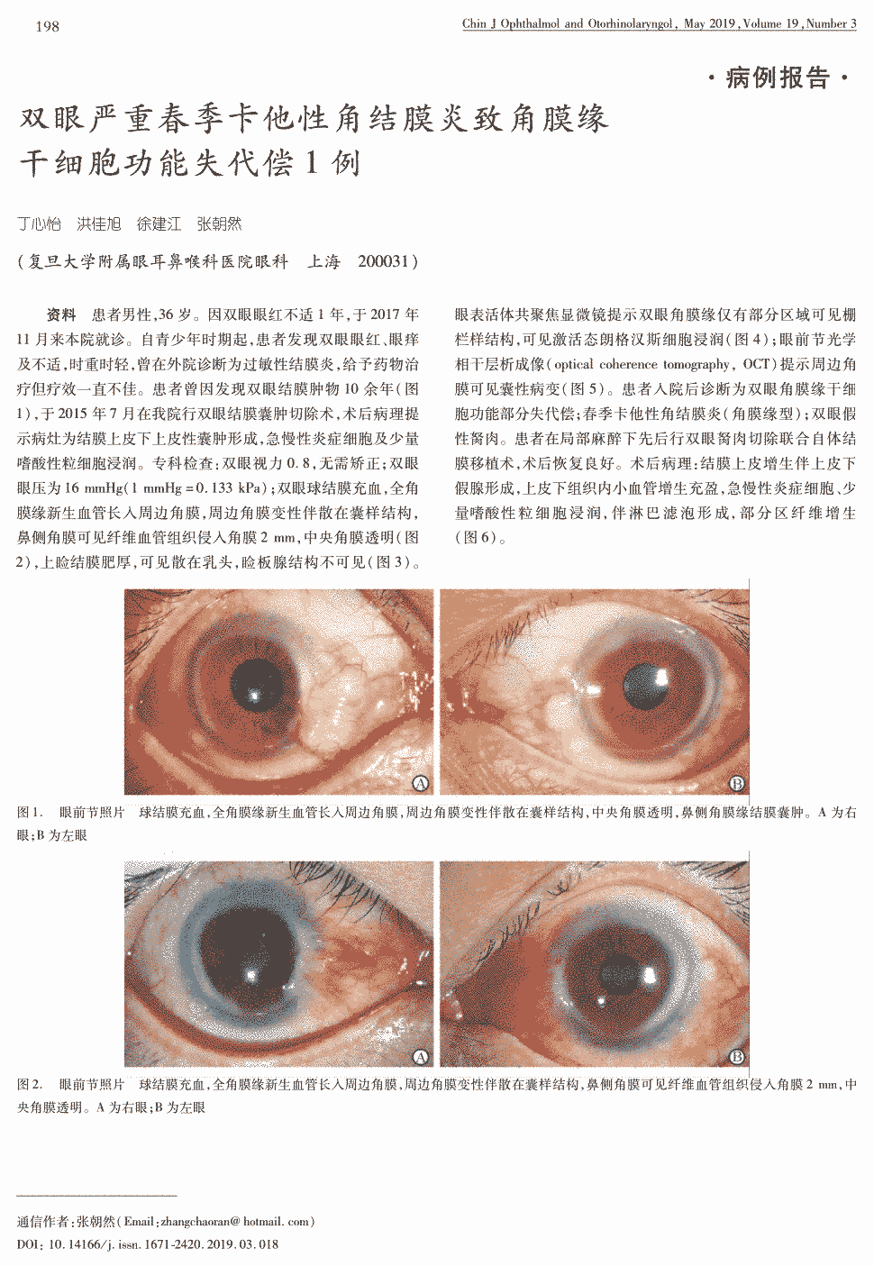 期刊双眼严重春季卡他性角结膜炎致角膜缘干细胞功能失代偿1例