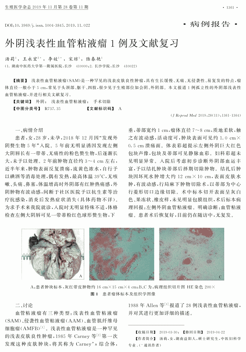 期刊外阴浅表性血管粘液瘤1例及文献复习       浅表性血管粘液瘤