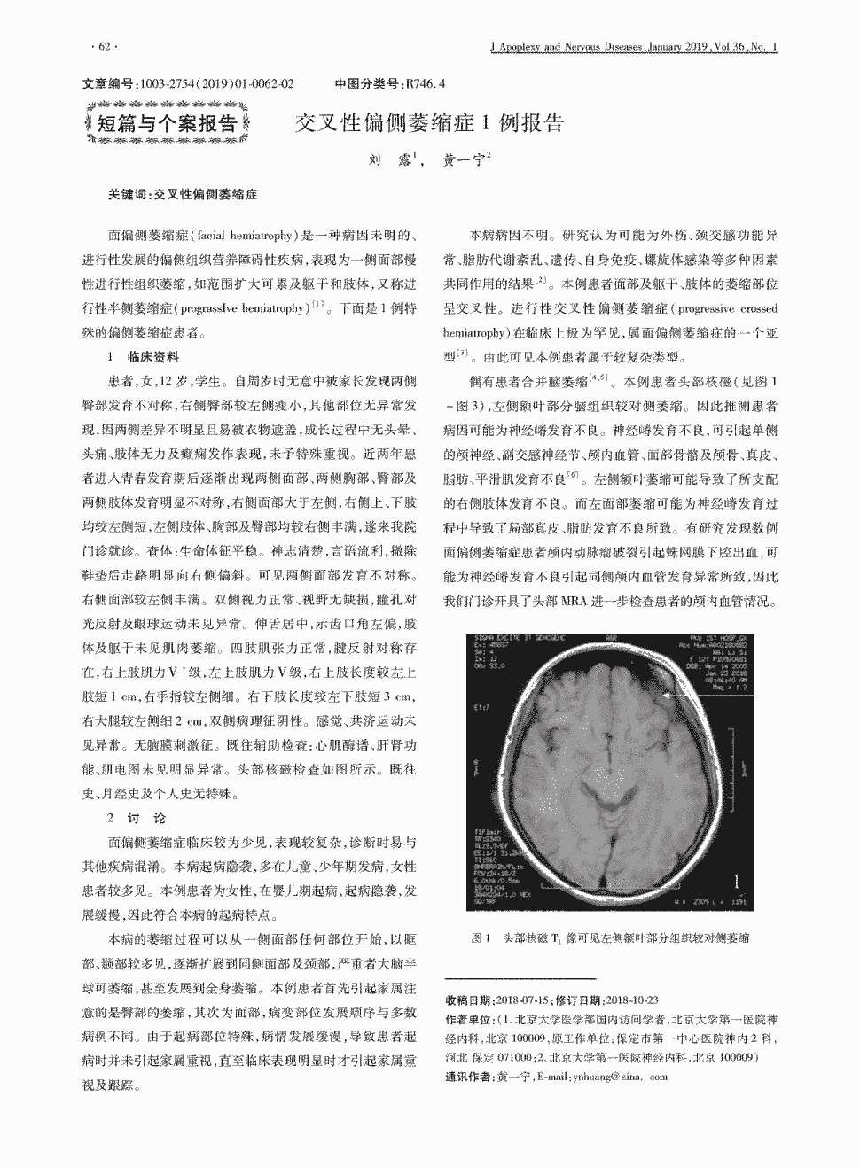 表现为一侧面部慢性进行性组织萎缩,如范围扩大可累及躯干和肢体,又称