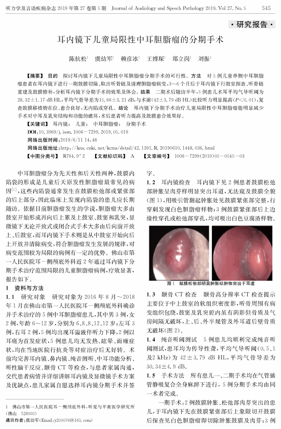 目的探讨耳内镜下儿童局限性中耳胆脂瘤分期手术的可行性