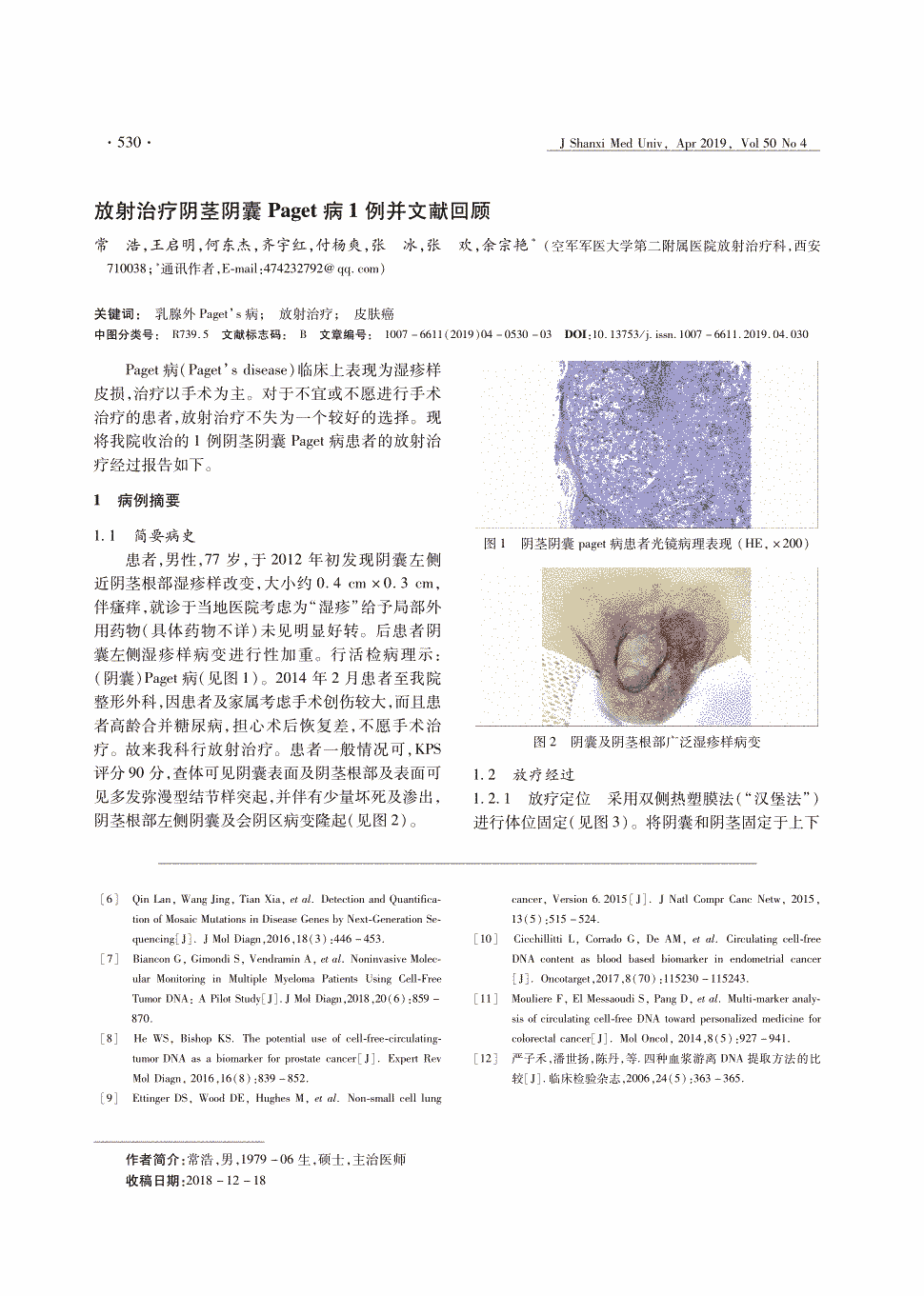 期刊放射治疗阴茎阴囊paget病1例并文献回顾