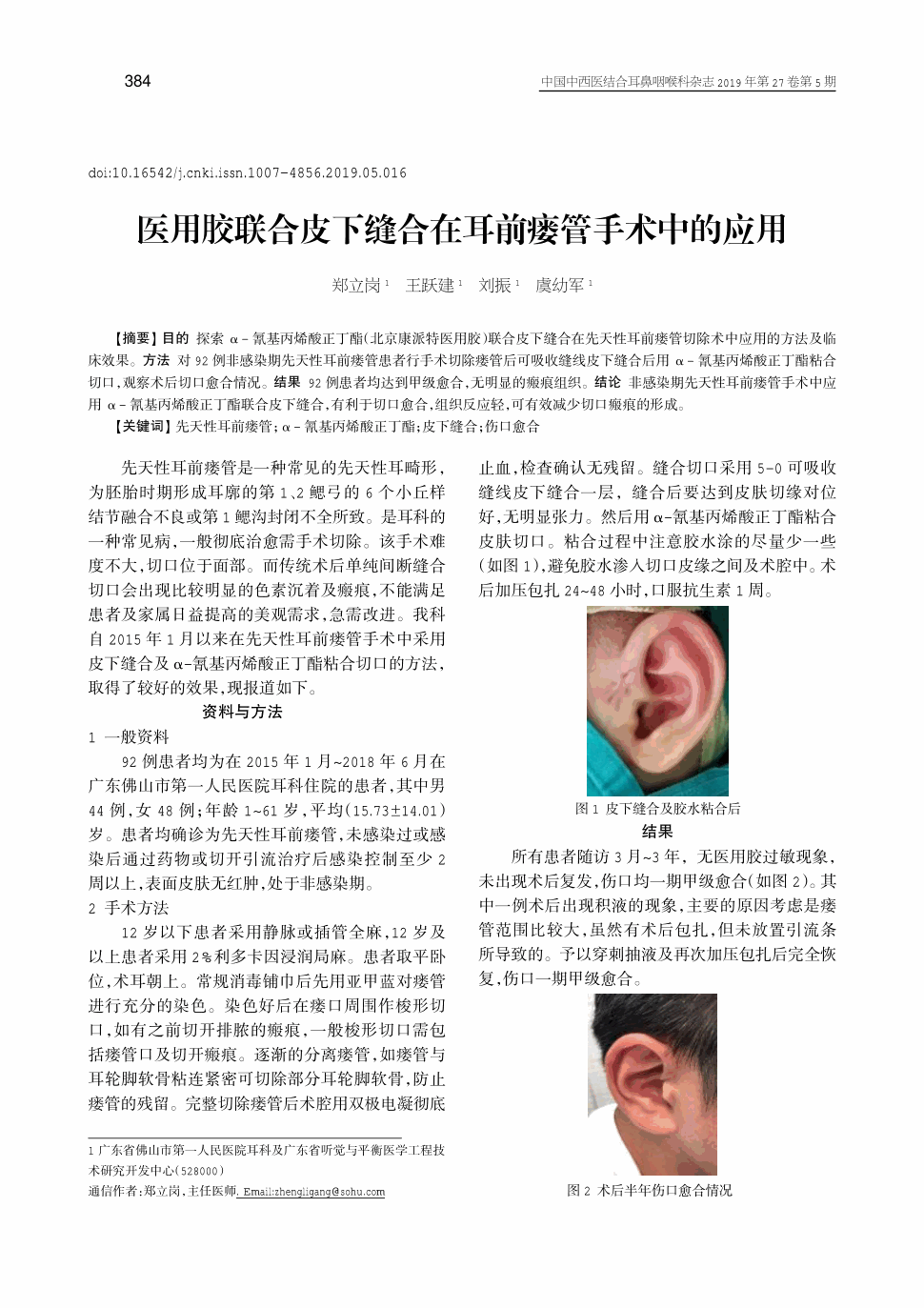 期刊医用胶联合皮下缝合在耳前瘘管手术中的应用      目的探索α