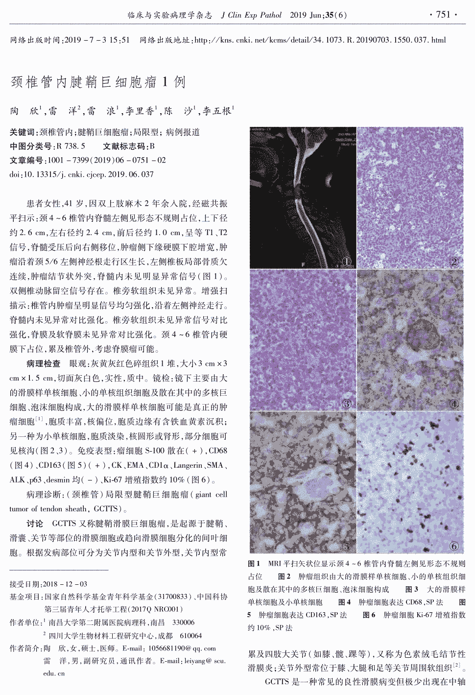 期刊颈椎管内腱鞘巨细胞瘤1例