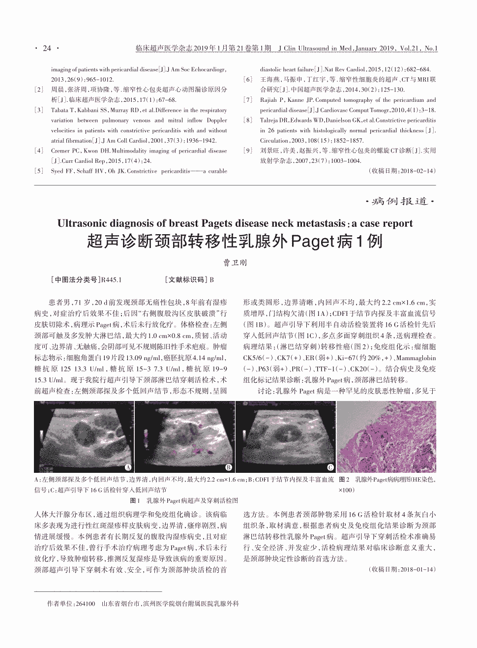 期刊超声诊断颈部转移性乳腺外paget病1例   患者男,71岁,20d前发现