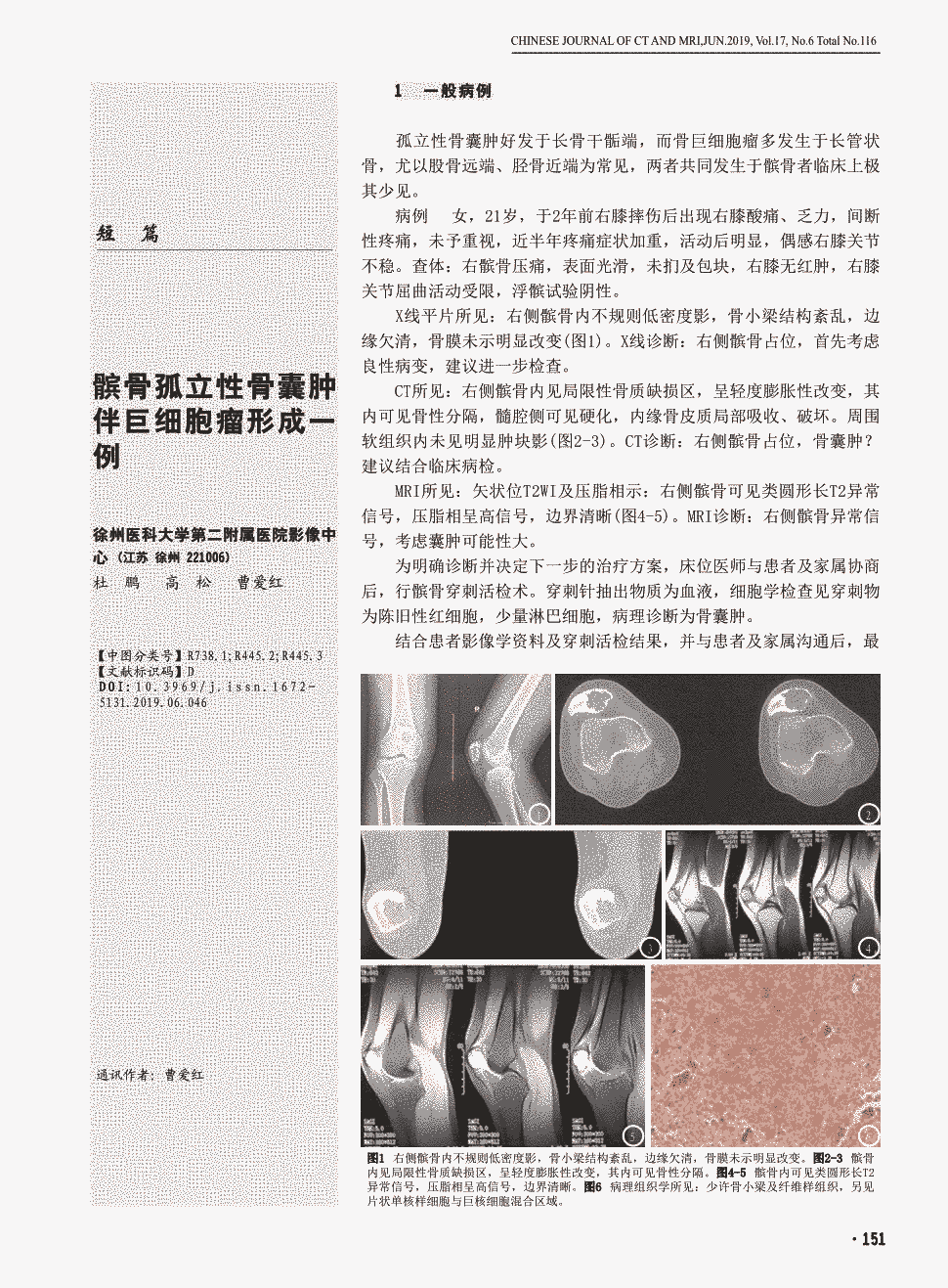 期刊髌骨孤立性骨囊肿伴巨细胞瘤形成一例     1一般病例孤立性骨