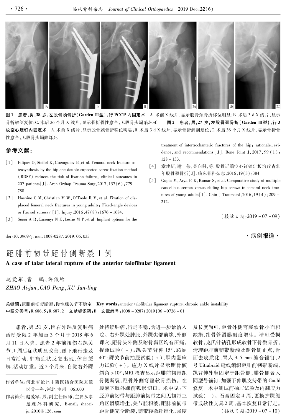 期刊距腓前韧带距骨侧断裂1例     患者,男,51岁,因右外踝反复肿痛