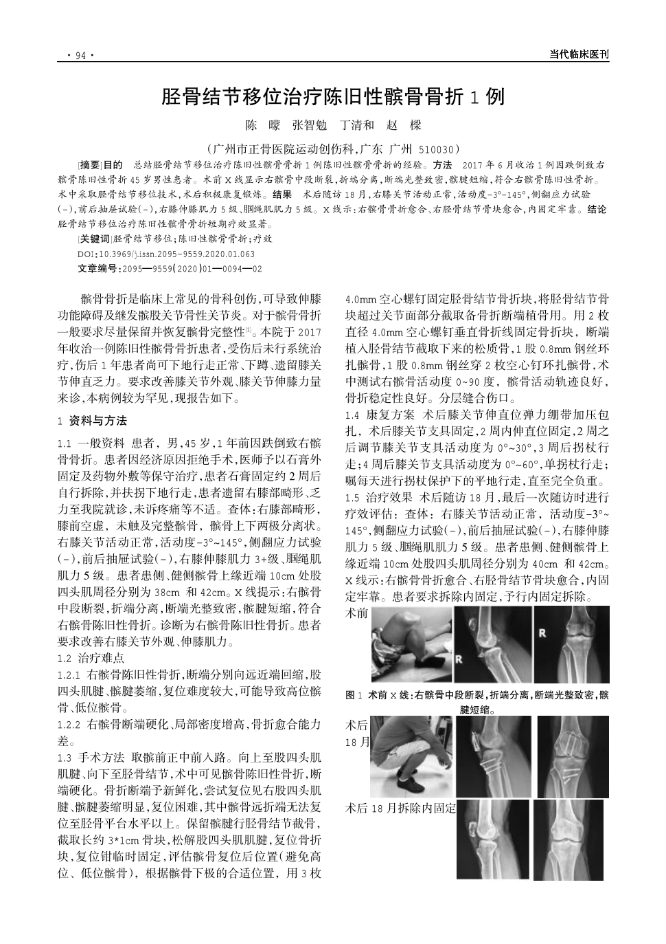 期刊胫骨结节移位治疗陈旧性髌骨骨折1例      目的总结胫骨结节移位